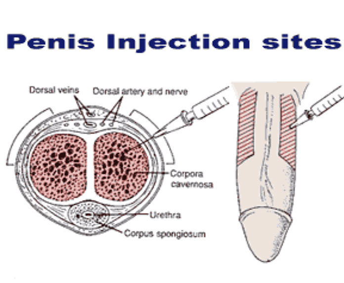 Penis Injection sites