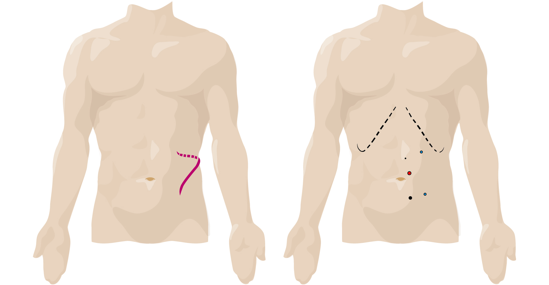 Nephrectomy: open surgical incision vs laparoscopic incision