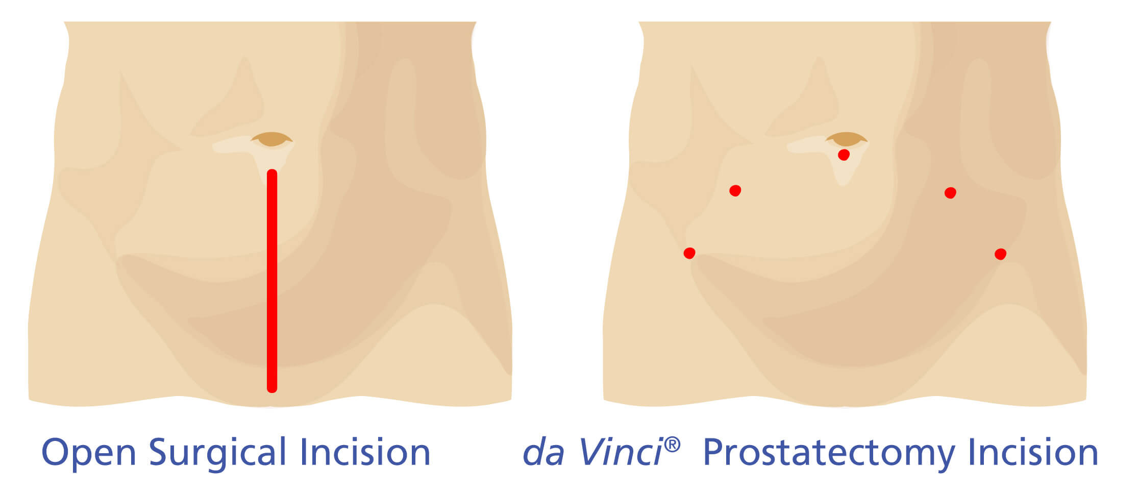 Prostatectomy: open surgical incision vs da Vinci prostatectomy incision